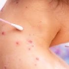 Secuelas de la viruela del simio.