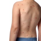 Las erupciones o rash en la piel son uno de los síntomas de la enfermedad.