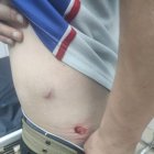 El arma que se usó era traumática. La víctima muestra la herida.