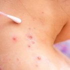 España confirma la segunda muerte por viruela del mono