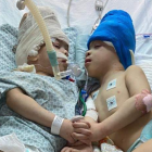 Bernardo y Arthur Lima fueron separados con éxito tras una operación de 27 horas.