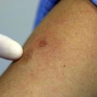 A un mes del anuncio del primer caso, ya suman siete los contagios en el país.