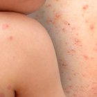 OMS dice que el brote de viruela del mono se debe a contagio entre personas