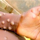 Los granos o protuberancias son características inherentes a este mal.