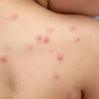 La viruela del mono se relacionaba con la encefalitis en brotes anteriores