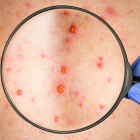 Hasta este viernes 23 Ecuador reportó 93 casos de viruela del mono, tras la vigilancia epidemiológica. De ellos, 25 recibieron el alta.