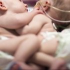 Nacen siameses unidos por el tórax y el abdomen en República Dominicana