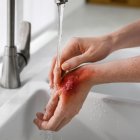 Lo complejo de la quemadura se relaciona con el tamaño y la profundidad de la lesión.