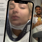 Keviam Cazo lleva collarín.