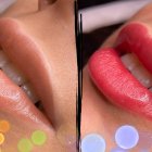 El procedimiento dura de 40 a 60 minutos.