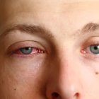 Referencial. Solo en algunas ocasiones, la conjuntivitis puede volverse infecciosa.