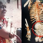 La paciente tenía miedo ir al doctor, por lo que no examinó sus molestias por años.