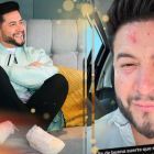 Jorge Heredia sufrió un accidente en su rostro.