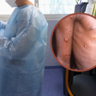 Para finales del 2022, la OMS alertó de un brote de este patógeno en los países de África.