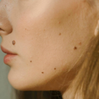 Aprende a evaluar tus lunares y detectar posibles signos de cáncer de piel