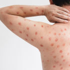 La erupción o lesiones cutáneas son síntomas característicos de la mpox.