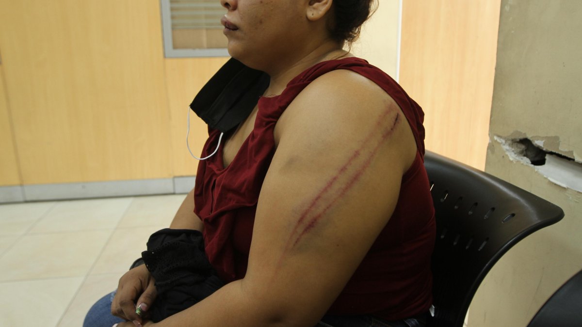 Por los latigazos, estas marcas quedaron en el cuerpo de la mujer.