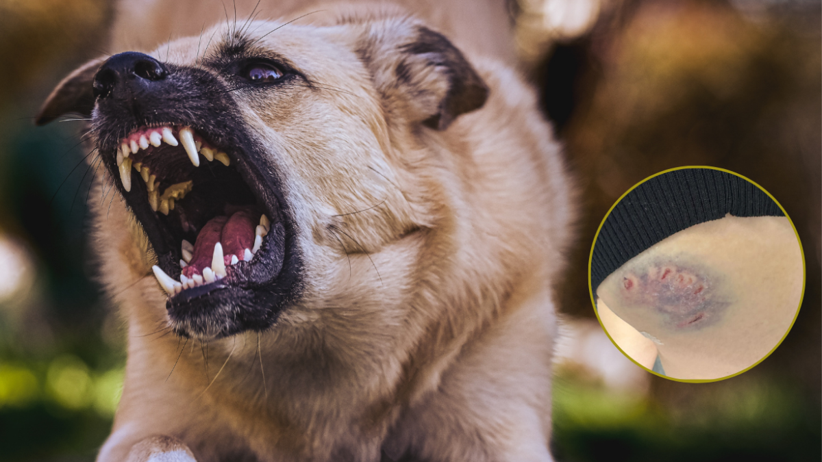 La joven fue mordida por un perro en su glúteo derecho.