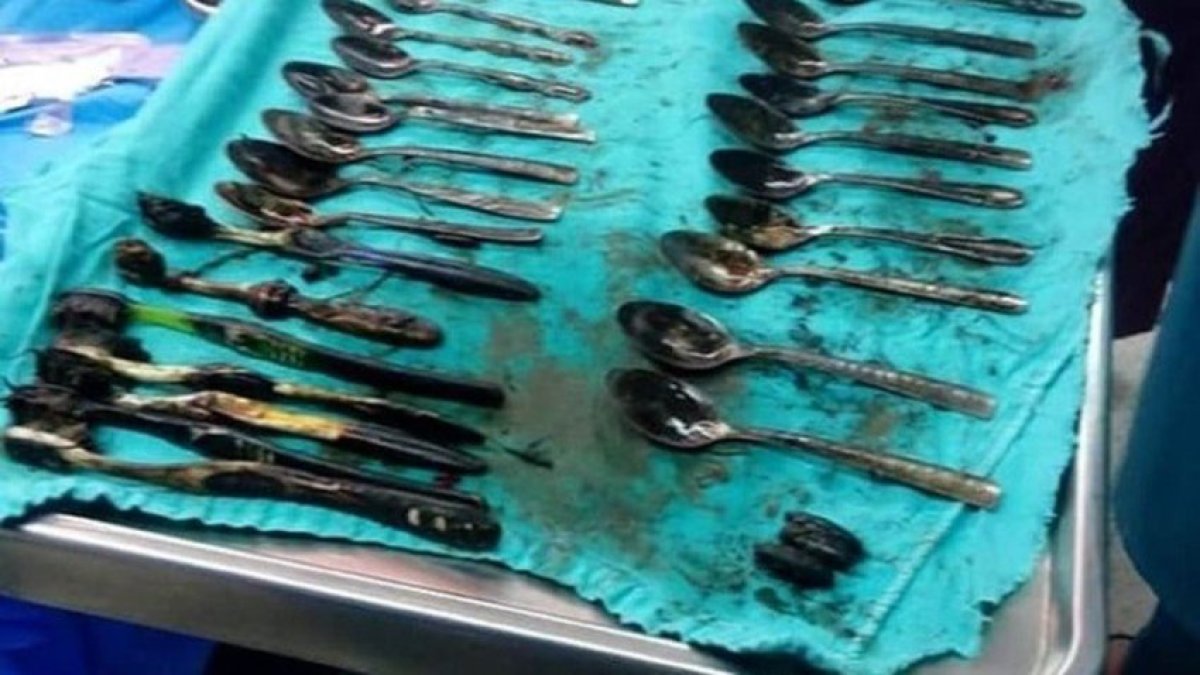 Dentro del estómago del chico encontraron 20 cucharas, 4 tenedores. 7 cepillos de dientes, un anillo y una cadena.