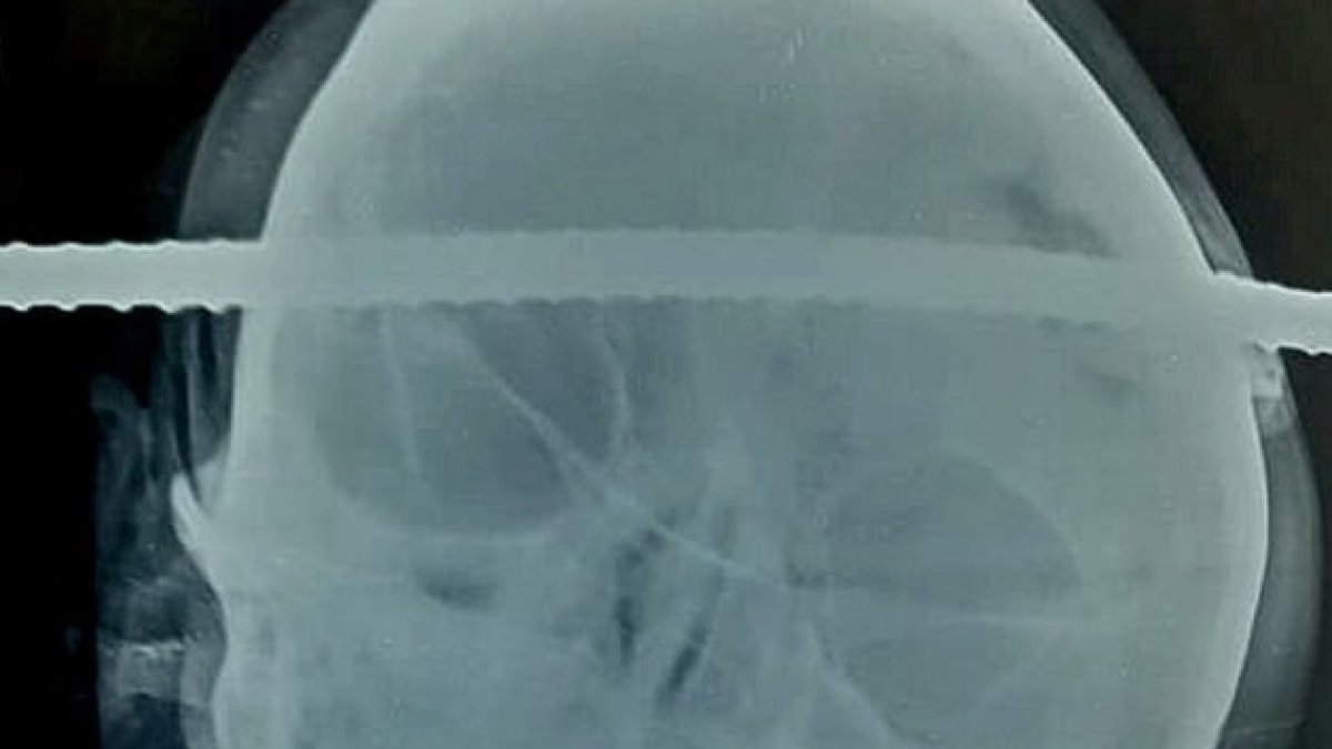 La operación para retirar el objeto duró una hora y media.