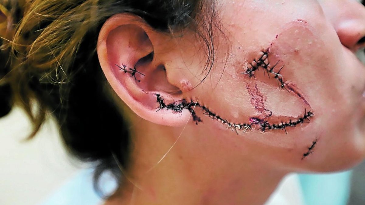 Cerca de 50 puntos de sutura le tuvieron que coger a la agredida en su rostro.
