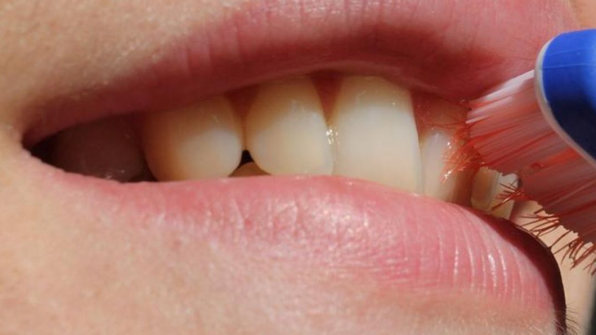 La bacteria que produce la gingivitis genera una bacteria capaz de destruir las células nerviosas del cerebro.