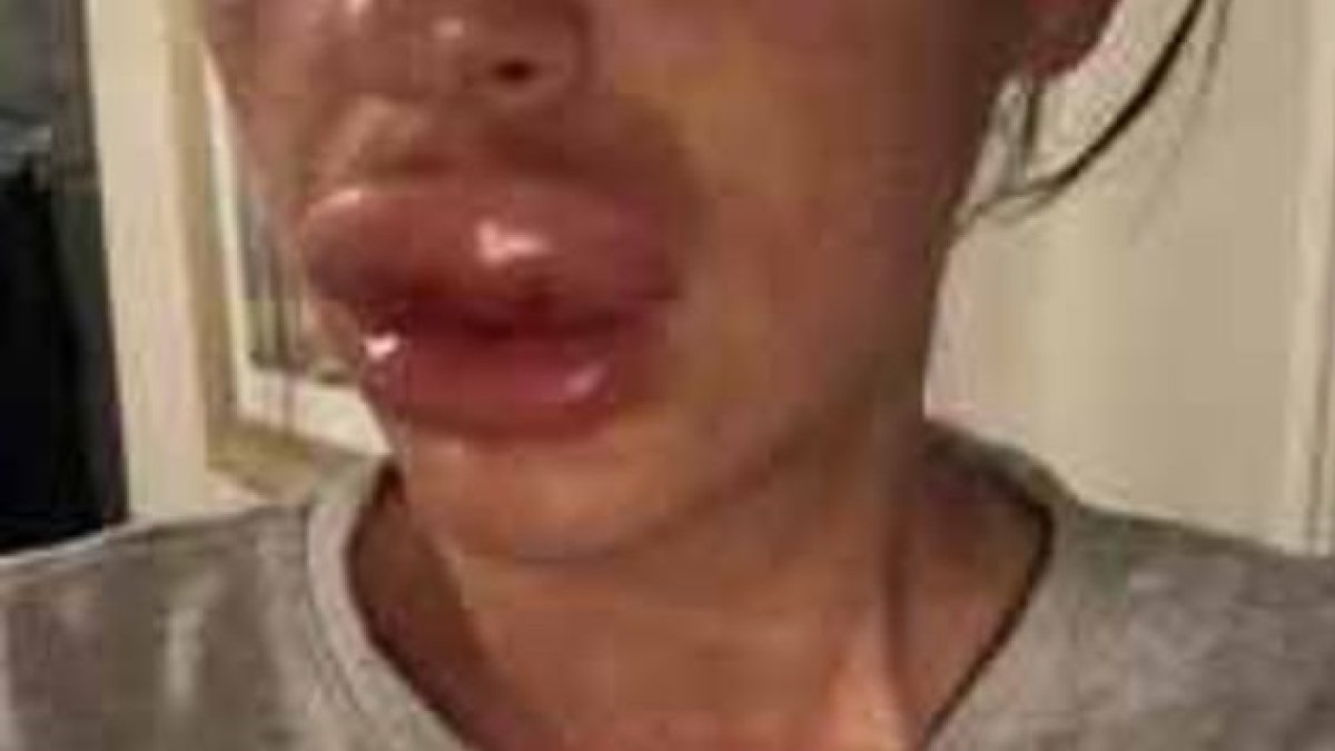 Knappier había acudido a una “fiesta de botox”, pero sin intención de inyectarse el líquido en su cuerpo.