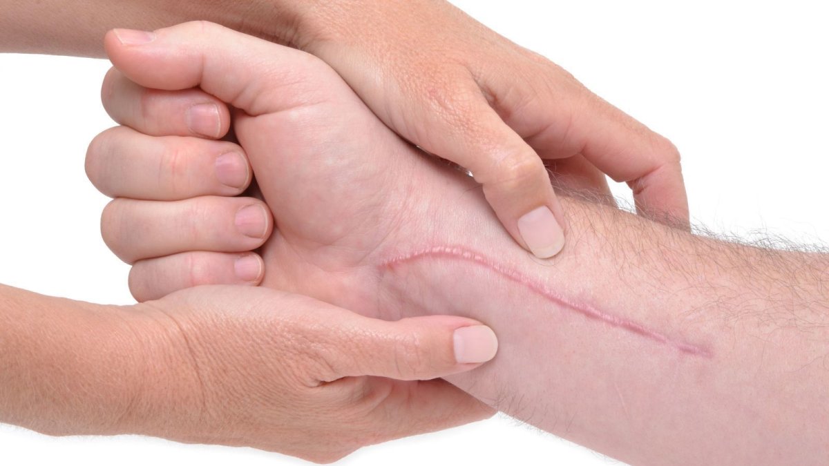 Ambos frutos tienen una dosis alta en vitamina C, la cual ayuda con la cicatrización. Tome en cuenta también a los antioxidantes.