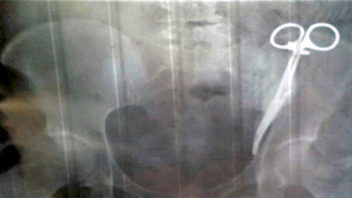 La radióloga llegó a pensar que se trataba de unas tijeras en el bolsillo de la mujer.