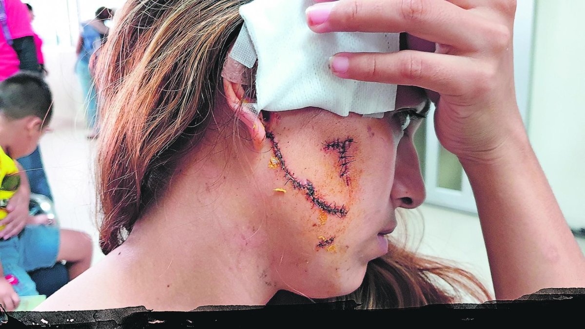 Una cicatriz de casi 12 centímetros cubre la mejilla derecha de la chica de 20 años.