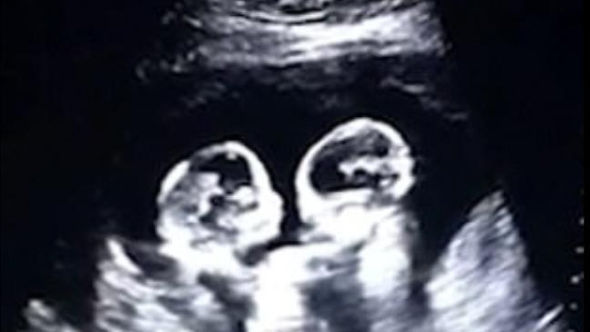 El audiovisual muestra el momento exacto en que una de las gemelas golpea a su hermana con el brazo.