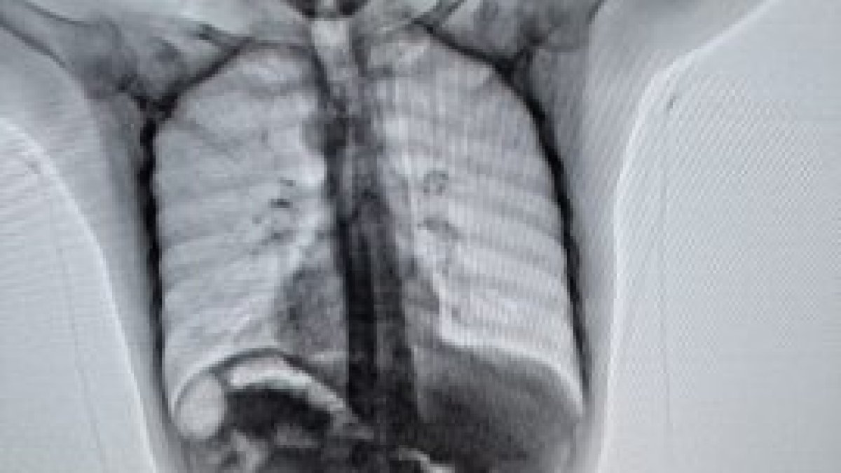 Se detectó que llevaba en su organismo 13.893 dosis de cocaína. Una placa radiográfica así lo confirmó