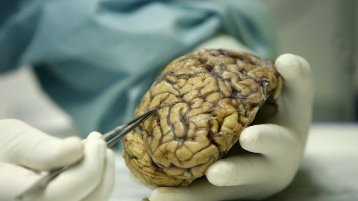 Un investigador analiza un cerebro humano enfermo de alzhéimer.