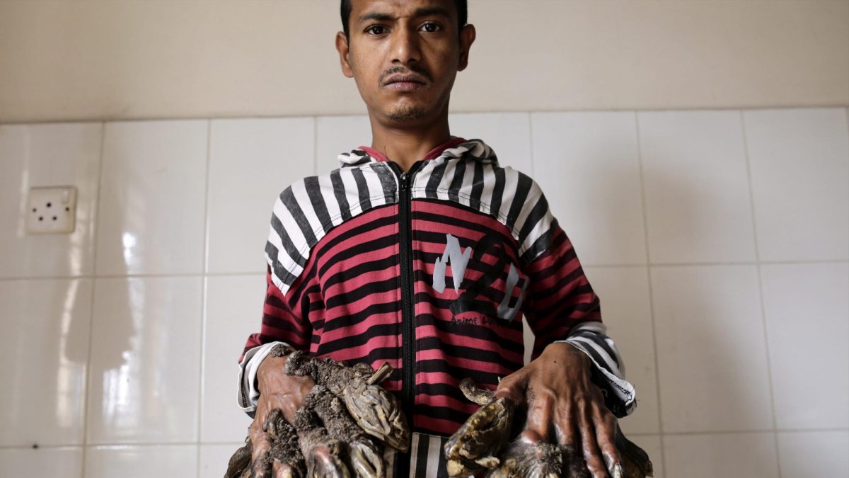 Abul Bajandar, diagnosticado con epidermodisplasia verruciforme