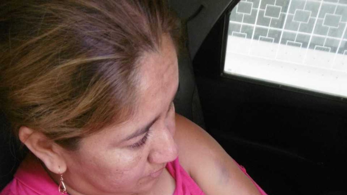 Alexis Magallanes Hidalgo muestra los moretones tras la agresión de su expareja