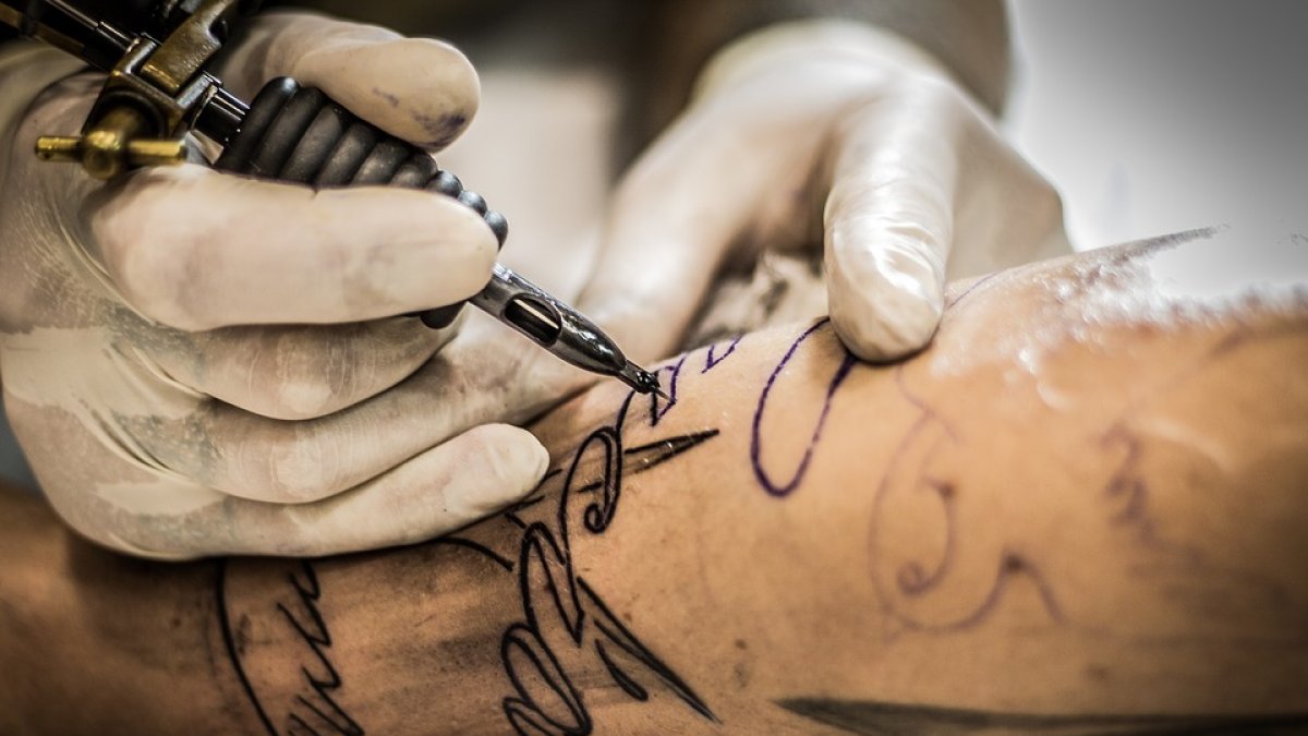El hombre seguirá con el procedimiento para remover el tatuaje