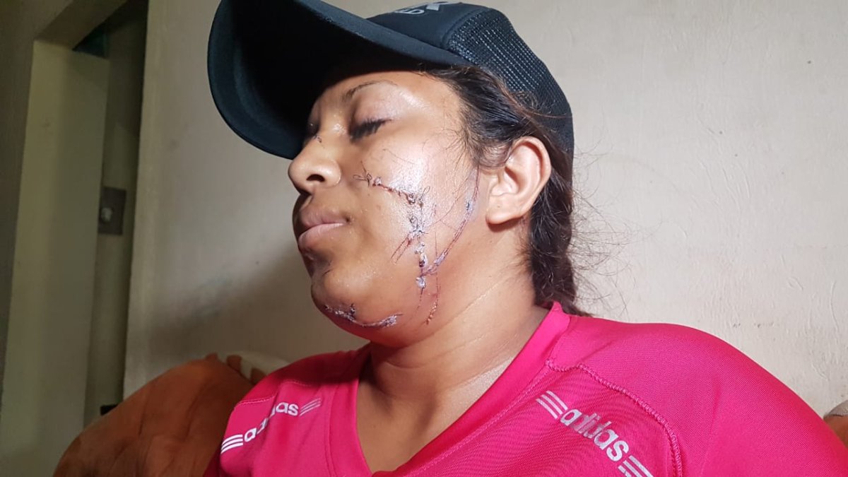 La joven de 26 años de edad resultó con cinco cortes en su rostro, tras ser agredida por un grupo de mujeres liderado por la pareja de su exconviviente.