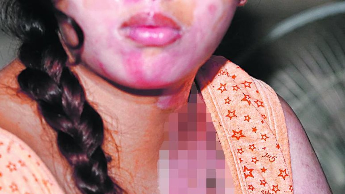 La joven aún tiene las secuelas del ataque recibido el pasado 10 de abril.