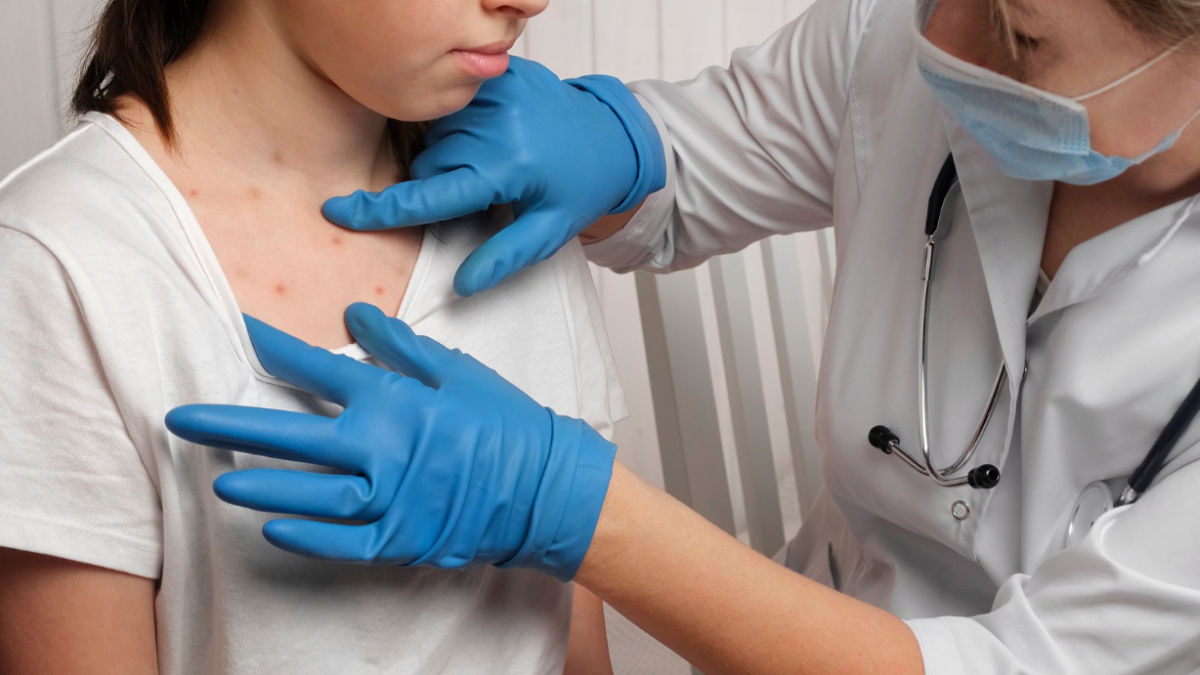 Las erupciones en la piel son el principal síntoma de viruela del mono.