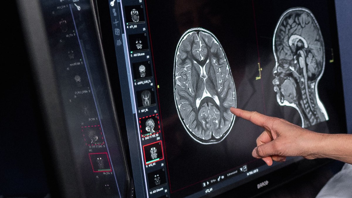 El descubrimiento detecta un camino en tres hitos hacia la pérdida de memoria