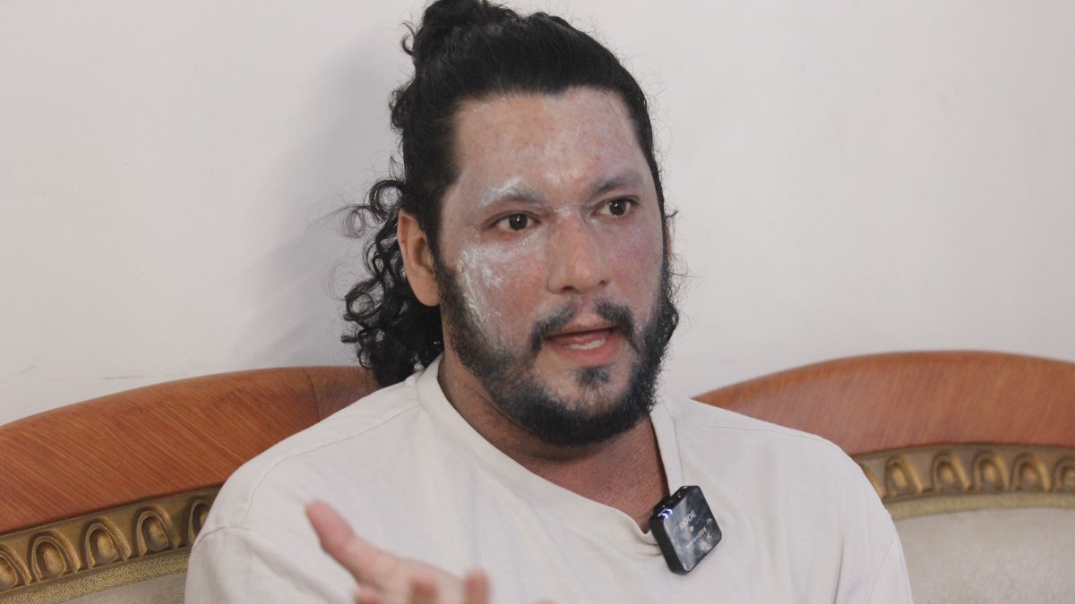 Felipe Crespo revela cómo la dermatitis y un accidente cambiaron su vida