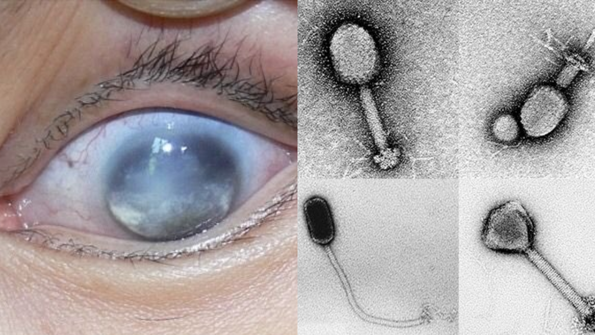 Un virus marino detectado en humanos en China enciende las alarmas tras causar pérdida de visión en los primeros casos vinculados al consumo de mariscos