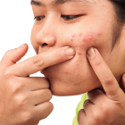 Logran reducir las cepas de las bacterias de la piel que causan el acné