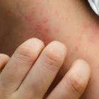 El vinagre puede calmar el dolor del Herpes zóster,