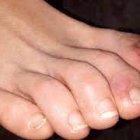 Algunos pacientes con Covid desarrollan un daño en los dedos de sus pies.