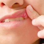 Las aftas pueden ser dolorosas. Evite cítricos y picantes.