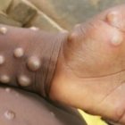 La ministra de Salud, Ximena Garzón, informó que el paciente sospechoso dio negativo a la prueba de la enfermedad.