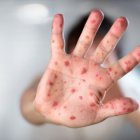 Argentina confirma un tercer caso de viruela de mono