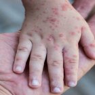 Detectan el primer caso de viruela del mono en Venezuela