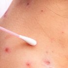 Bolivia reporta dos casos sospechosos de viruela del mono